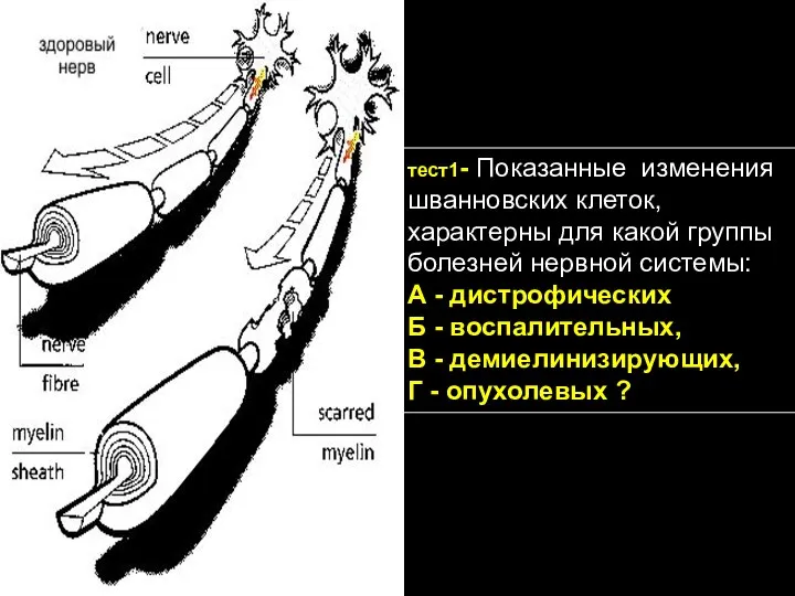 тест1- Показанные изменения шванновских клеток, характерны для какой группы болезней нервной системы: