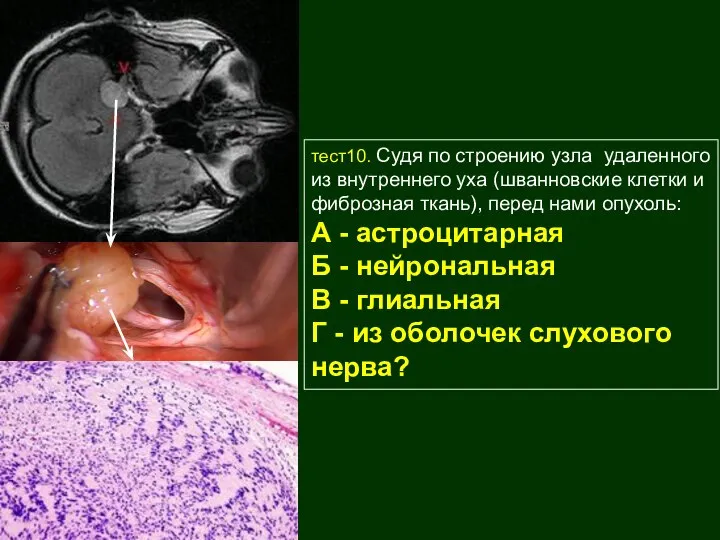 тест10. Судя по строению узла удаленного из внутреннего уха (шванновские клетки и