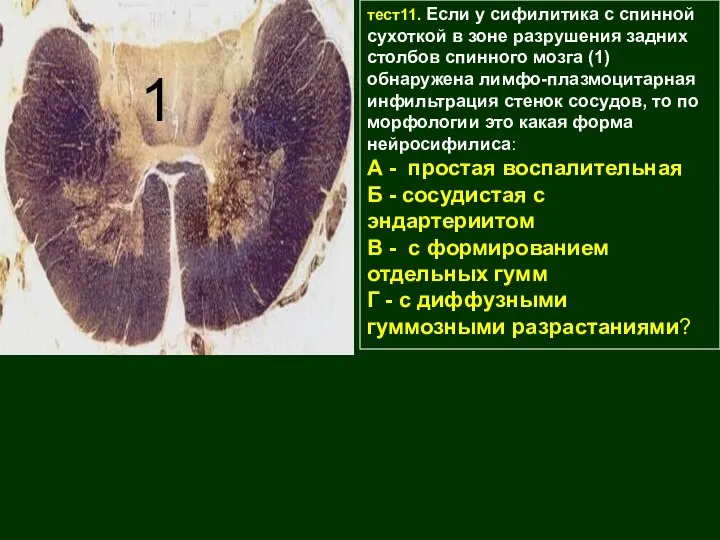 Клинико-морфологические особенности нейросифилиса (643- тест11. Если у сифилитика с спинной сухоткой в