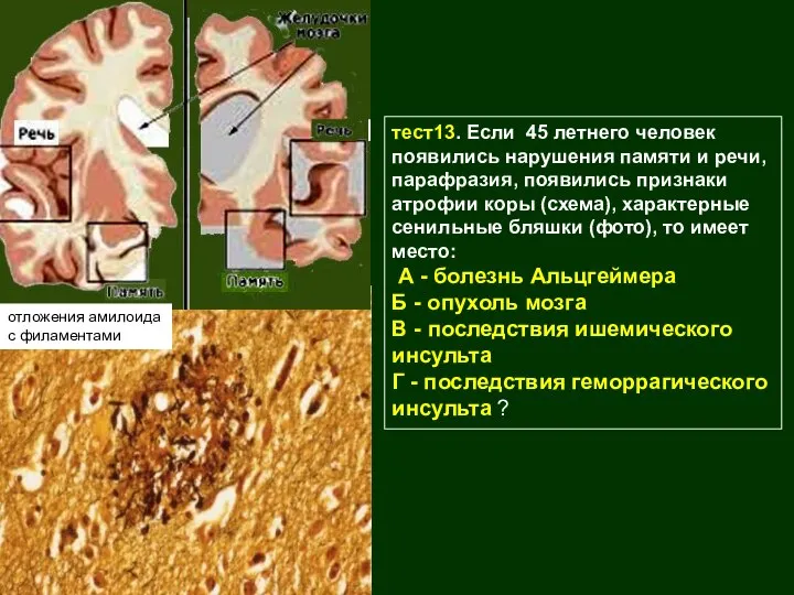 тест13. Если 45 летнего человек появились нарушения памяти и речи,парафразия, появились признаки