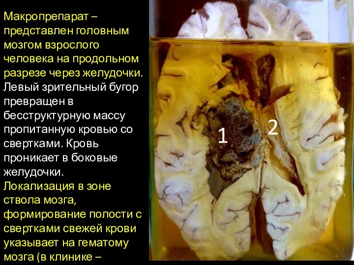 1 2 Макропрепарат – представлен головным мозгом взрослого человека на продольном разрезе