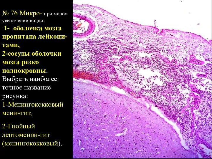 № 76 Микро- при малом увеличении видно: 1- оболочка мозга пропитана лейкоци-тами,