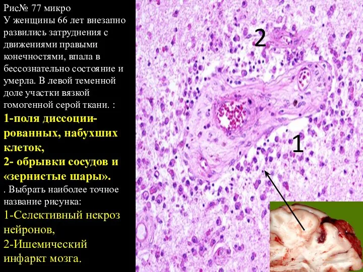 1 2 Рис№ 77 микро У женщины 66 лет внезапно развились затруднения