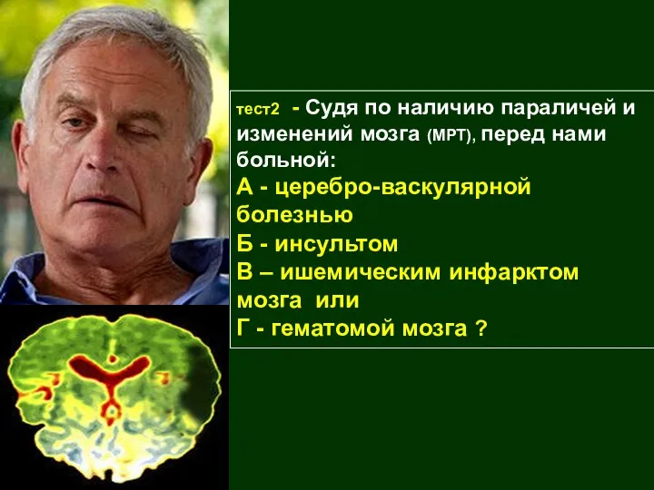 тест2 - Судя по наличию параличей и изменений мозга (МРТ), перед нами