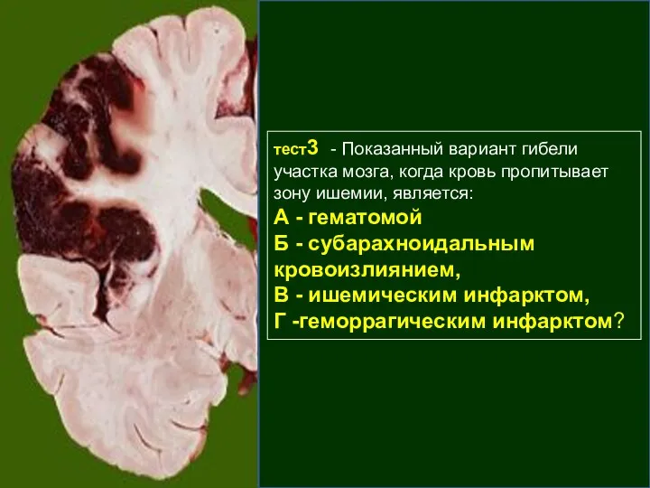 тест3 - Показанный вариант гибели участка мозга, когда кровь пропитывает зону ишемии,