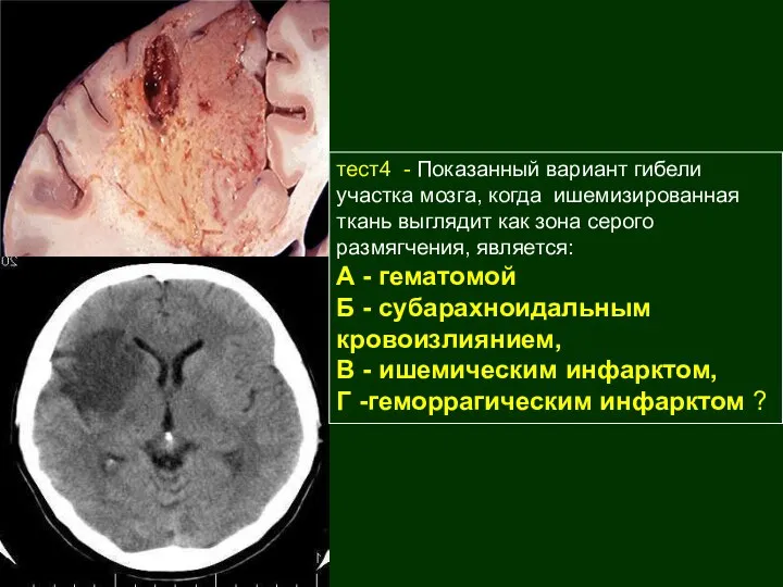 тест4 - Показанный вариант гибели участка мозга, когда ишемизированная ткань выглядит как