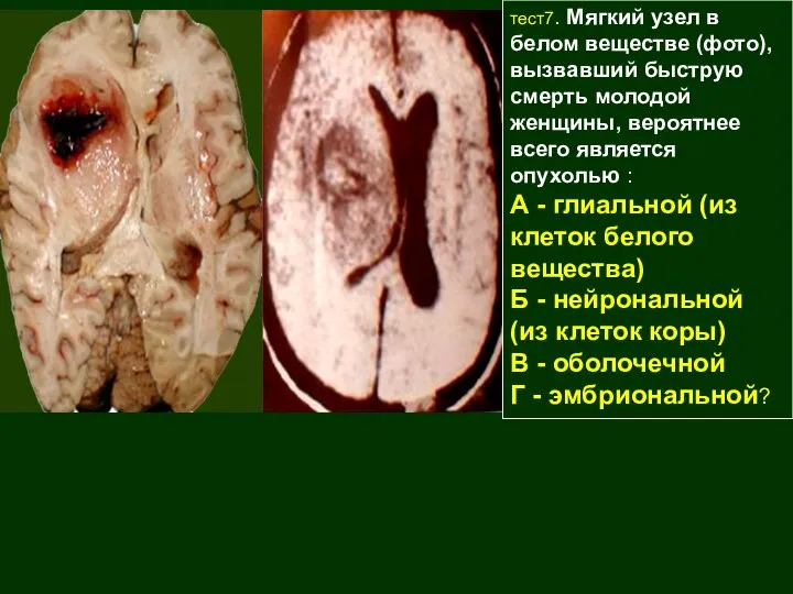 тест7. Мягкий узел в белом веществе (фото), вызвавший быструю смерть молодой женщины,