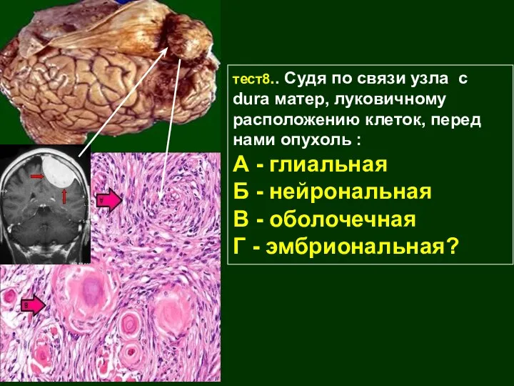 тест8.. Судя по связи узла с dura матер, луковичному расположению клеток, перед