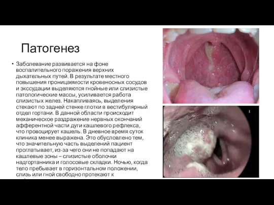 Патогенез Заболевание развивается на фоне воспалительного поражения верхних дыхательных путей. В результате