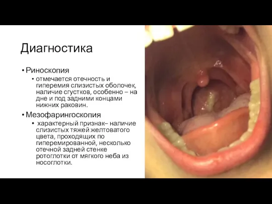 Диагностика Риноскопия отмечается отечность и гиперемия слизистых оболочек, наличие сгустков, особенно –