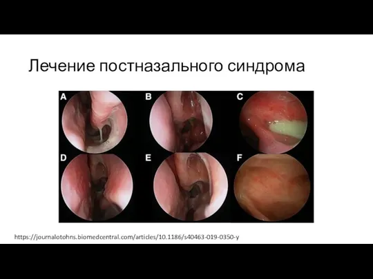 Лечение постназального синдрома https://journalotohns.biomedcentral.com/articles/10.1186/s40463-019-0350-y