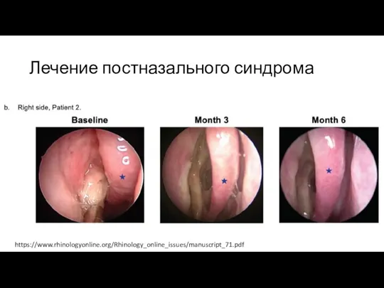 Лечение постназального синдрома https://www.rhinologyonline.org/Rhinology_online_issues/manuscript_71.pdf