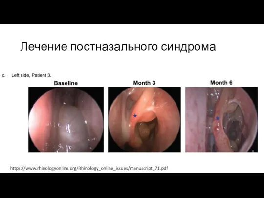 Лечение постназального синдрома https://www.rhinologyonline.org/Rhinology_online_issues/manuscript_71.pdf