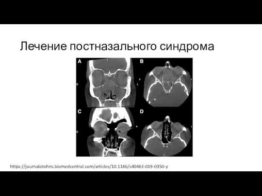 Лечение постназального синдрома https://journalotohns.biomedcentral.com/articles/10.1186/s40463-019-0350-y