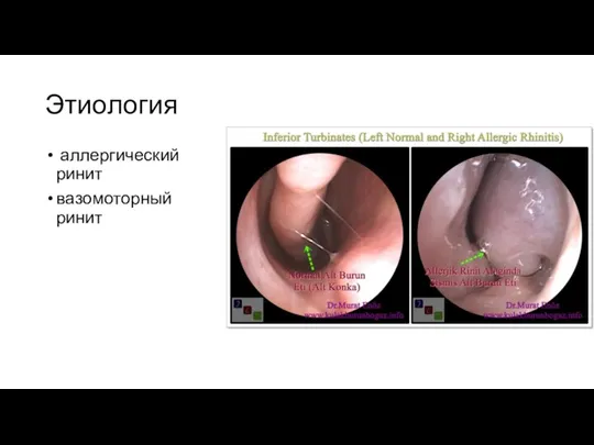 Этиология аллергический ринит вазомоторный ринит