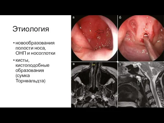 Этиология новообразования полости носа, ОНП и носоглотки кисты, кистоподобные образования (сумка Торнвальдта)