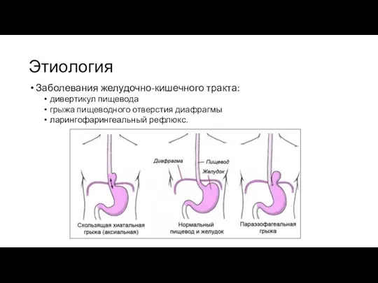 Этиология Заболевания желудочно-кишечного тракта: дивертикул пищевода грыжа пищеводного отверстия диафрагмы ларингофарингеальный рефлюкс.