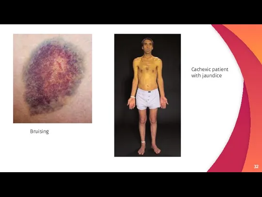 Bruising Cachexic patient with jaundice