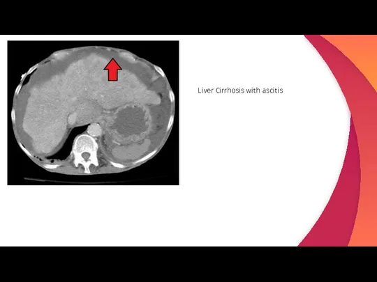 Liver Cirrhosis with ascitis