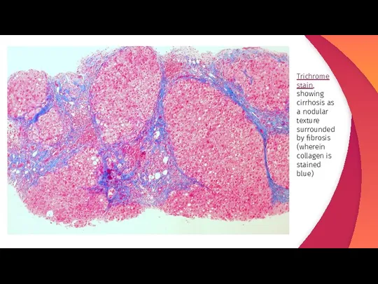 Trichrome stain, showing cirrhosis as a nodular texture surrounded by fibrosis (wherein collagen is stained blue)