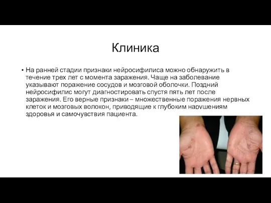 Клиника На ранней стадии признаки нейросифилиса можно обнаружить в течение трех лет