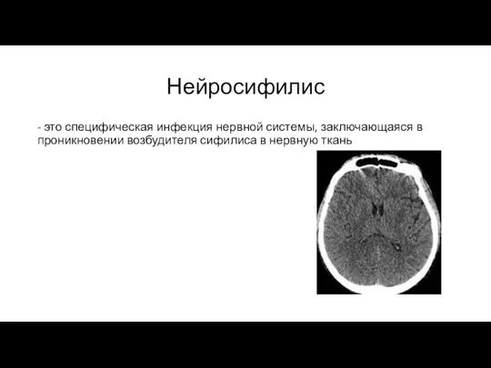 Нейросифилис - это специфическая инфекция нервной системы, заключающаяся в проникновении возбудителя сифилиса в нервную ткань