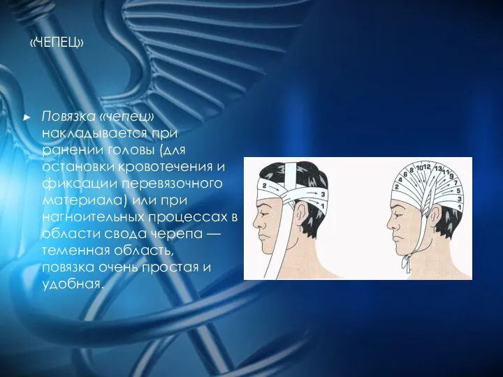 «ЧЕПЕЦ» Повязка «чепец» накладывается при ранении головы (для остановки кровотечения и фиксации