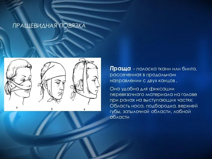 ПРАЩЕВИДНАЯ ПОВЯЗКА Праща – полоска ткани или бинта, рассеченная в продольном направлении