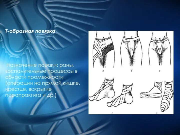 Т-образная повязка Назначение повязки: раны, воспалительные процессы в области промежности, (операции на