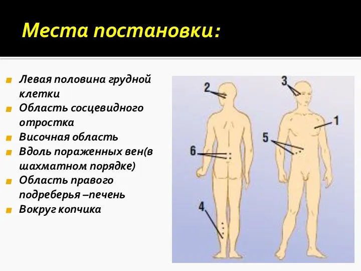 Места постановки: Левая половина грудной клетки Область сосцевидного отростка Височная область Вдоль