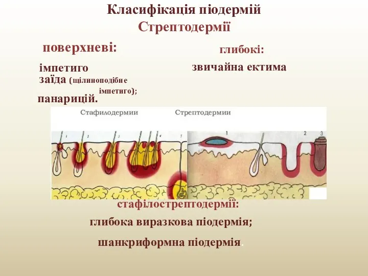 Класифікація піодермій Стрептодермії поверхневі: глибокі: імпетиго заїда (щілиноподібне імпетиго); панарицій. звичайна ектима