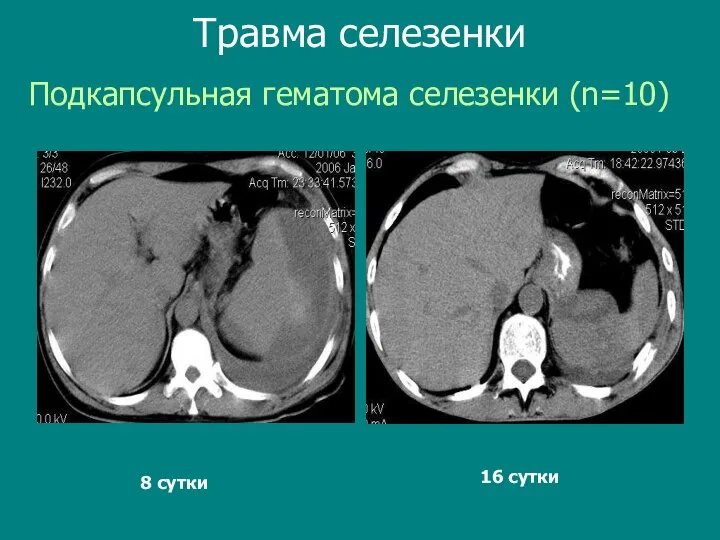 Подкапсульная гематома селезенки (n=10) Травма селезенки 8 сутки 16 сутки