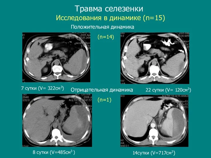 Травма селезенки 8 сутки (V=485см3 ) 14cутки (V=717см3) 7 сутки (V= 322см3)