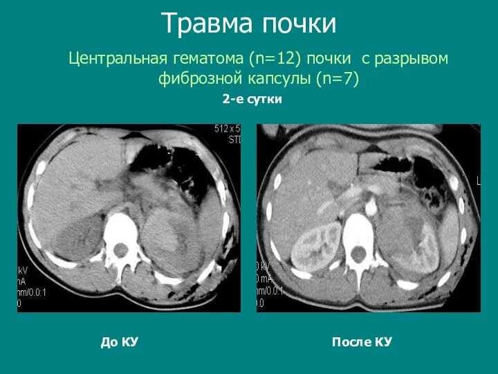 До КУ После КУ Центральная гематома (n=12) почки c разрывом фиброзной капсулы