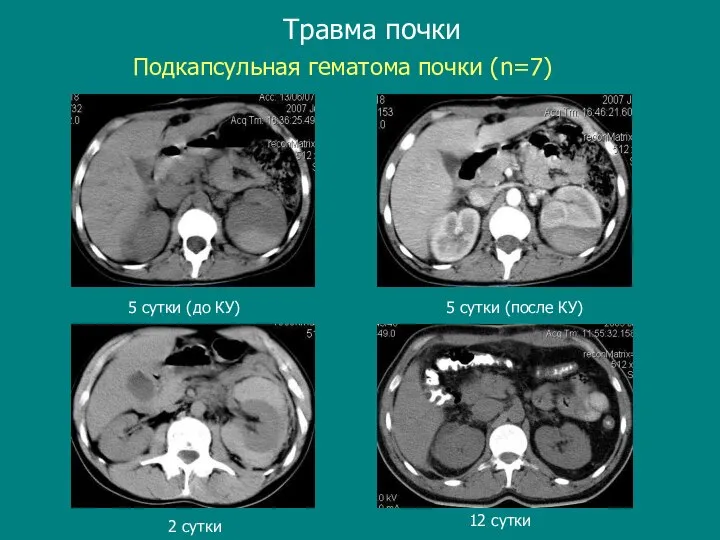 Травма почки 2 сутки 12 cутки 5 сутки (до КУ) Подкапсульная гематома