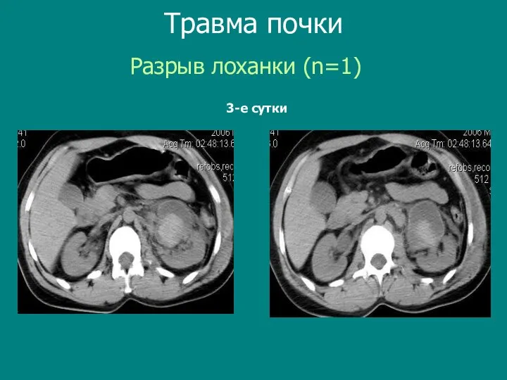 Разрыв лоханки (n=1) Травма почки 3-е сутки