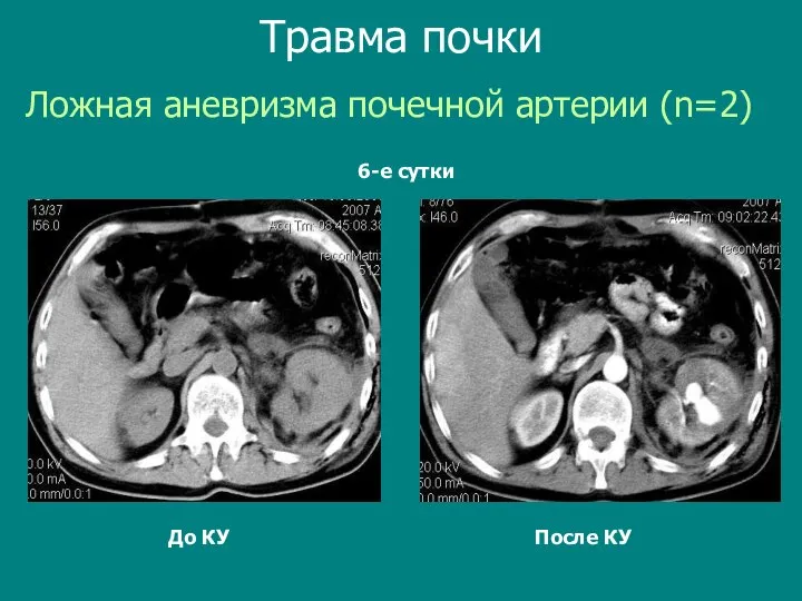 До КУ После КУ Ложная аневризма почечной артерии (n=2) Травма почки 6-е сутки