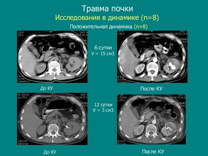 Травма почки После КУ До КУ Исследования в динамике (n=8) Положительная динамика