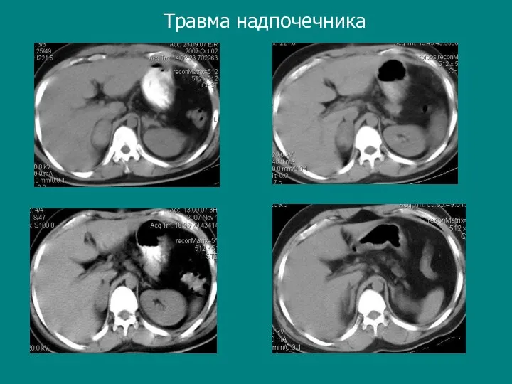 Травма надпочечника