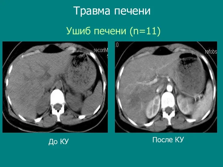 Травма печени До КУ После КУ Ушиб печени (n=11)