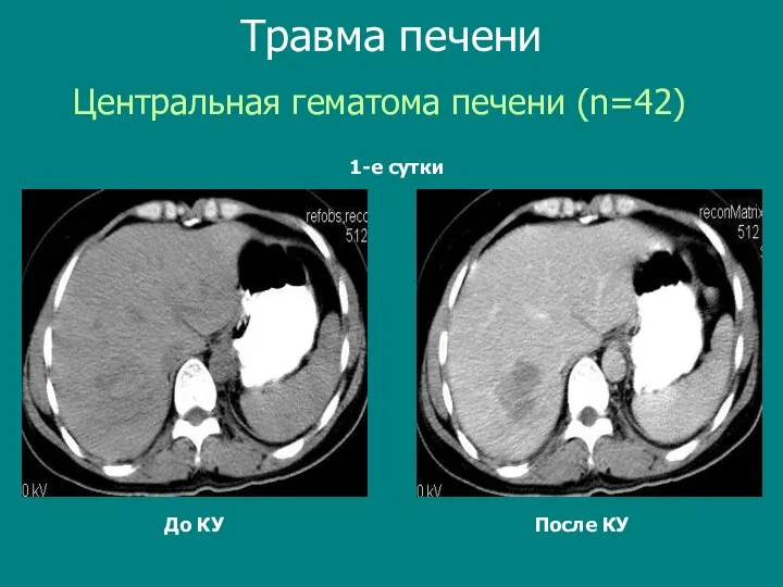 До КУ После КУ Центральная гематома печени (n=42) Травма печени 1-е сутки