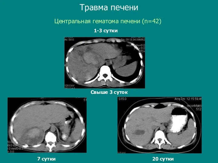 Свыше 3 суток Центральная гематома печени (n=42) Травма печени 1-3 сутки Свыше