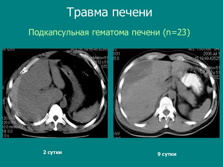 Подкапсульная гематома печени (n=23) Травма печени 9 сутки 2 сутки