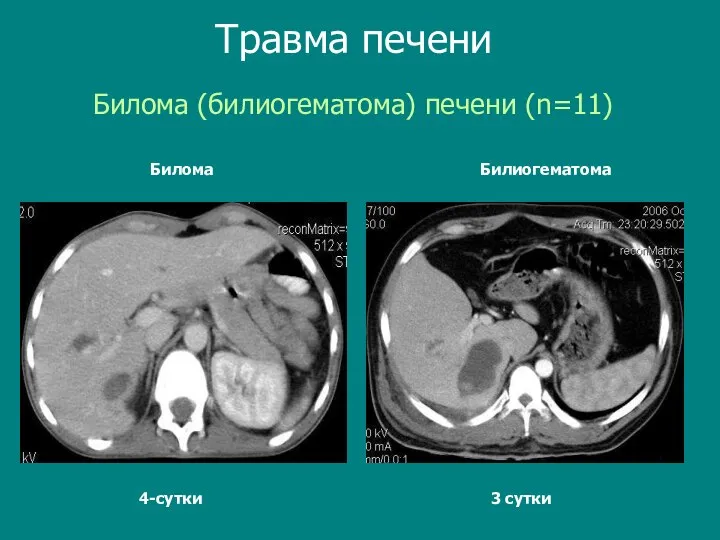 Билома (билиогематома) печени (n=11) Травма печени Билиогематома Билома 4-сутки 3 сутки