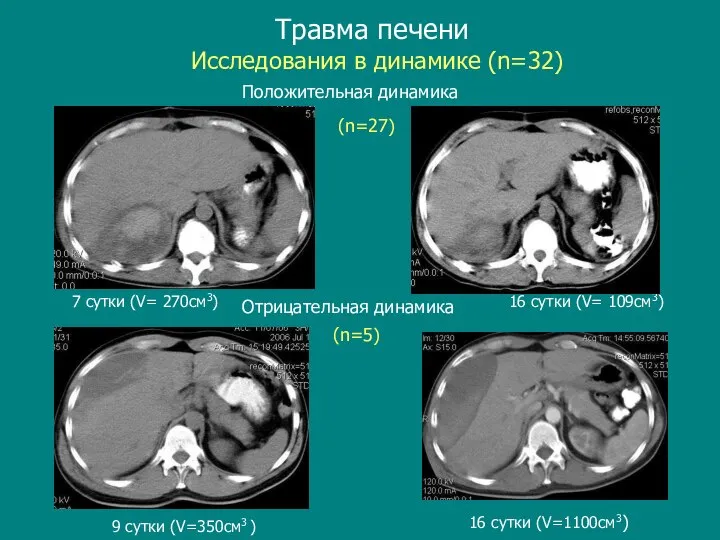 Травма печени 9 сутки (V=350см3 ) 16 cутки (V=1100см3) 7 сутки (V=