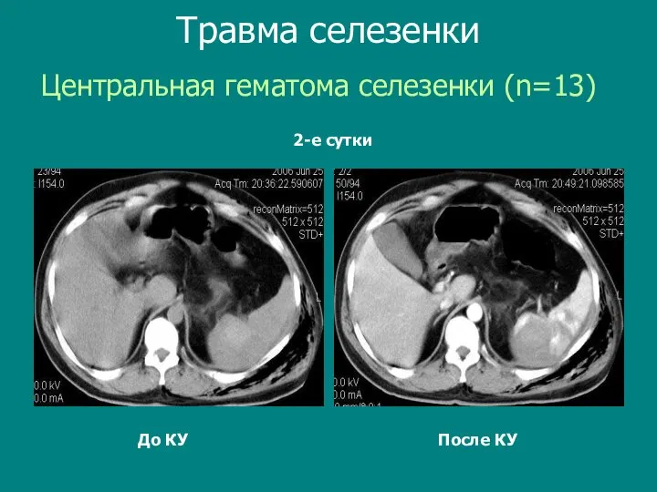 До КУ После КУ Центральная гематома селезенки (n=13) Травма селезенки 2-е сутки