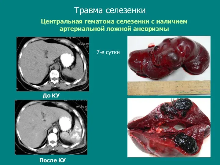 Травма селезенки Центральная гематома селезенки с наличием артериальной ложной аневризмы До КУ После КУ 7-е сутки