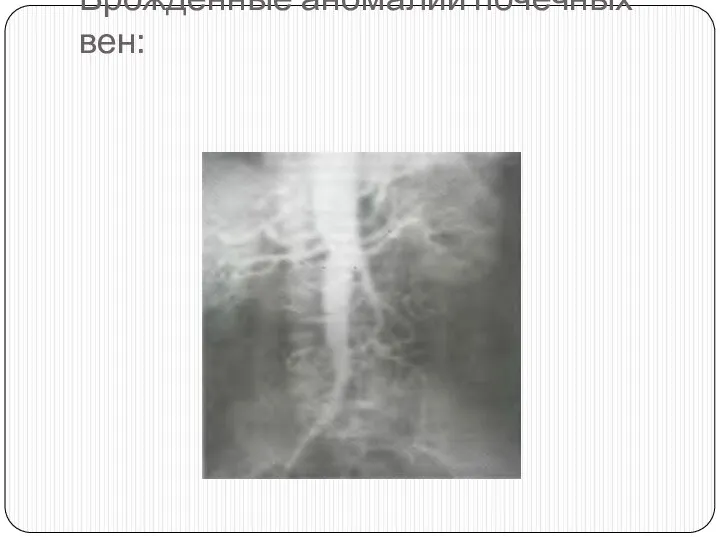 Врожденные аномалии почечных вен: