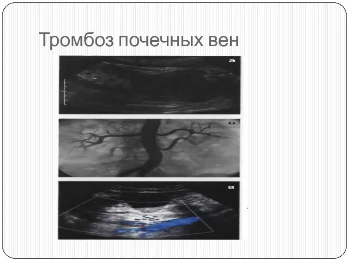 Тромбоз почечных вен