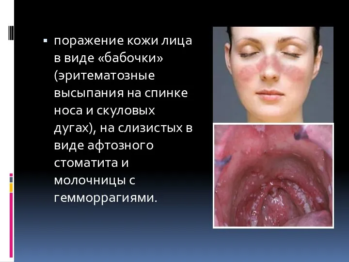 поражение кожи лица в виде «бабочки»(эритематозные высыпания на спинке носа и скуловых